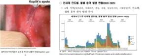 홍역 확산세 세계적 경고…한국서도 유입·2차 감염 증가