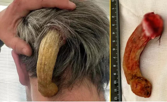 각질종 수술, 피부의 뿔, 13cm 종양, 러시아 희귀 종양, 피부각질각