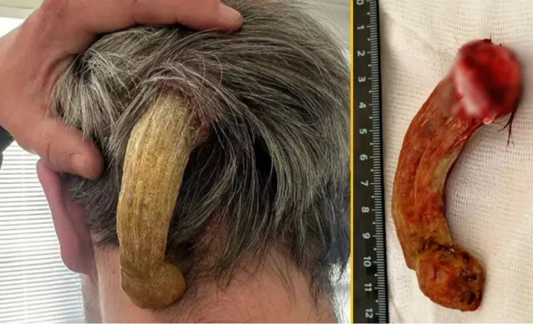 각질종 수술, 피부의 뿔, 13cm 종양, 러시아 희귀 종양, 피부각질각