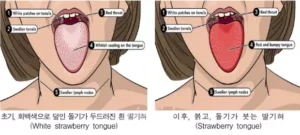 성홍열 환자 2.5배 급증…“10세 미만 어린이 각별한 주의 필요”