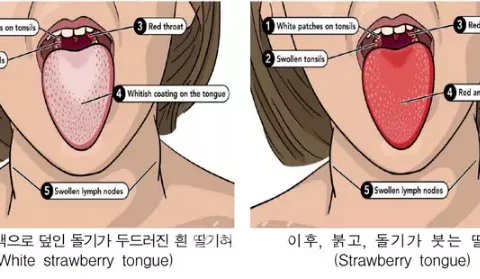 성홍열