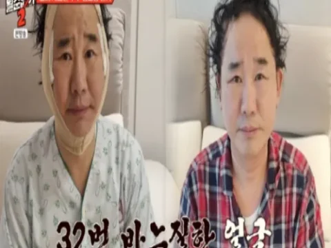 최양락 성형