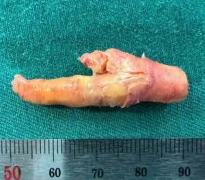 담배 두 갑씩 피운 55세 남성, 경동맥서 닭발 모양 플라크 제거