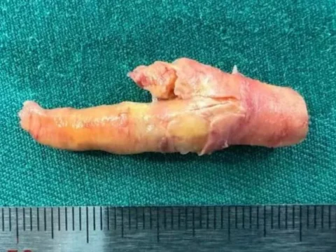 경동맥에서 길이 4cm에 달하는 플라크를 제거한 중국 남성의 사연이 전해졌다.